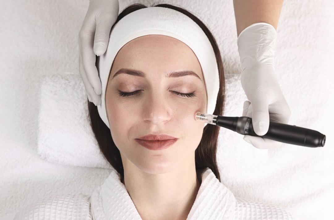 Microneedling-Behandlung im Gesicht